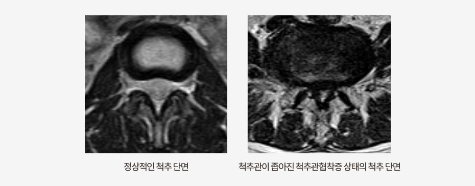 척추관협착증