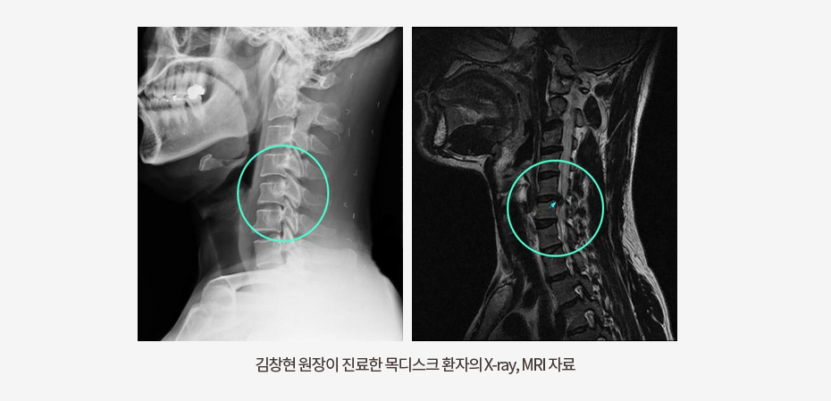 목디스크/일자목